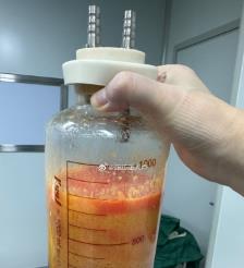 临猗水动力吸脂手术要做多久？